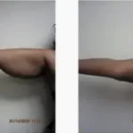 Arm Liposuction Results Washington DC, near Dupont Circle and Georgetown-Dr. Drew Varano
