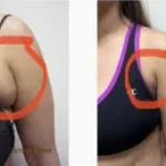 Bra Fat Liposuction Results Washington DC, Dupont Circle, Georgetown near Arlington Virginia-Dr. Drew Varano