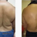 Back Lipo Results Washington DC, Dupont Circle, Georgetown, Arlington Virginia-Dr. Drew Varano