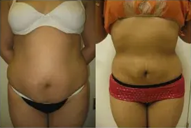 Liposuction Abdomen (women)
