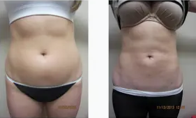 Liposuction Abdomen (women)