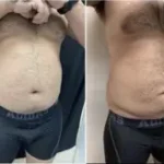 Liposuction Male Results Washington DC- Medical Cosmetic Enhancements