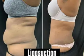 Liposuction Abdomen (women)