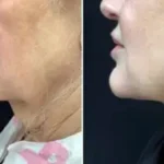 Renuvion neck Results Washington DC-Dr. Drew Varano
