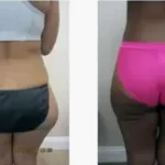 Liposuction thigh Results Washington DC- Medical Cosmetic Enhancements