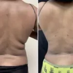 Back Lipo Results Washington DC, Dupont Circle, Georgetown, Arlington Virginia-Dr. Drew Varano
