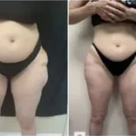 Inner and Outer thigh Liposuction Results Washington DC-Dr. Drew Varano
