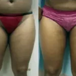 Inner thigh Liposuction Results Washington DC-Dr. Drew Varano