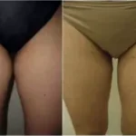 Liposuction inner thighs Results Washington DC-Dr. Drew Varano