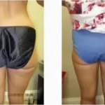 Lipo Results outer thighs Washington DC- Medical Cosmetic Enhancements