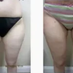 Liposuction inner thighs Results Washington DC-Dr. Drew Varano