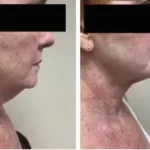 Renuvion ( J-Plasma) Results Washington DC-Dr. Drew Varan