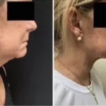 Renuvion ( J-Plasma) Results Washington DC -Dr. Drew Varano