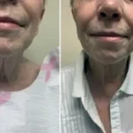 Renuvion ( J-Plasma) Results Washington DC-Dr. Drew Varano