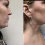Renuvion (J-Plasma) Results Washington DC-Dr. Drew Varano