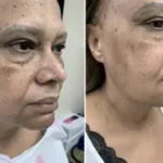 Renuvion ( J-Plasma) Lower face and neck Results Washington DC-Dr. Drew Varano