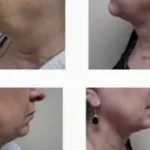 Renuvion (J-Plasma) Results Washington DC-Dr. Drew Varano