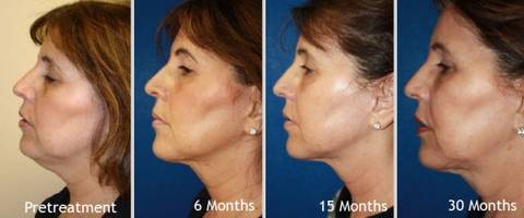 Thermitight, Renuvion, J plasma offered Medical Cosmetic Washington DC , Dupont Circle, Georgetown, Arlington, Bethesda, submental neck liposuction, double chin liposuction