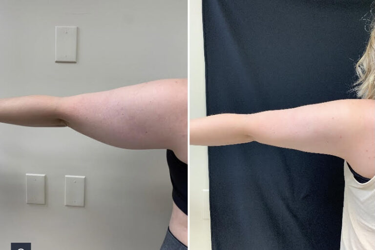 Liposuction 360, Lipo, Laser Liposuction, J plasma, Washington DC , Dupont Circle, Georgetown, Arm Liposuction, Medical Cosmetic