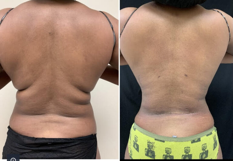 Liposuction 360, Lipo, Laser Liposuction, J plasma, Washington DC , Dupont Circle, Georgetown, Arlington, Bethesda, Back Liposuction, Bra roll liposuction, Medical Cosmetic