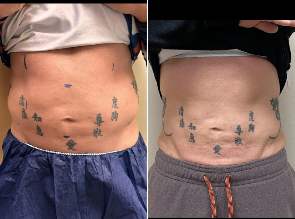 Coolsculpting GLP-1 Zepbound Washington DC medical cosmetic