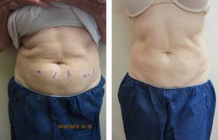 Coolsculpting elite Abdomen Dupont circle washington DC