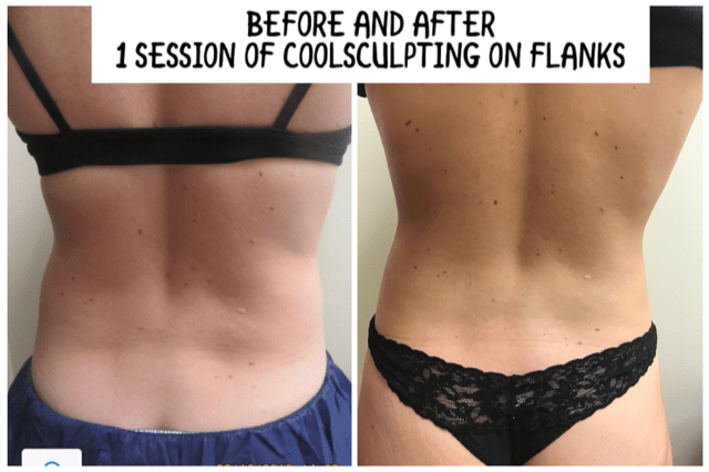 Coolsculpting Elite flanks