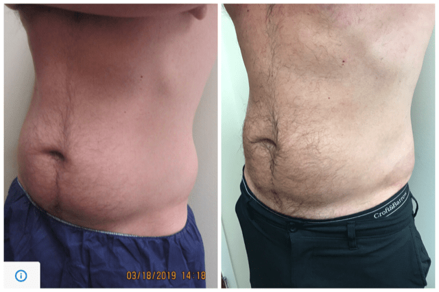 Coolsculpting male abdomen Medical Cosmetic Washington DC between Dupont Circle and Georgetown serving Arlington Virginia