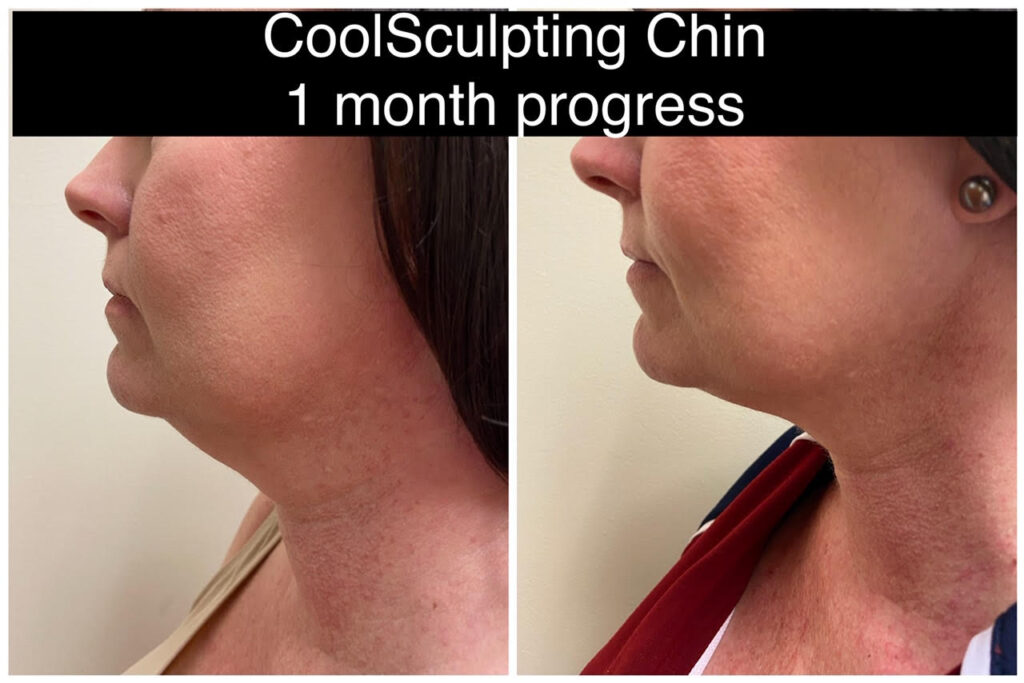 Coolsculpting neck Medical Cosmetic Washington DC, Georgetown and dupont circle serving Alrlington Virginia