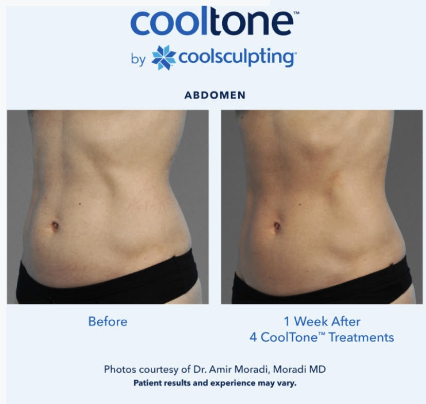 Cooltone Medical Cosmetic Washington DC BBL, muscle builder. Emsculpt, Dupont Circle, Brazillian Butt lift
