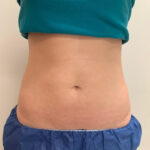 Cooltone Medical Cosmetic Washington DC BBL, muscle builder. Emsculpt, Dupont Circle, Brazillian Butt lift