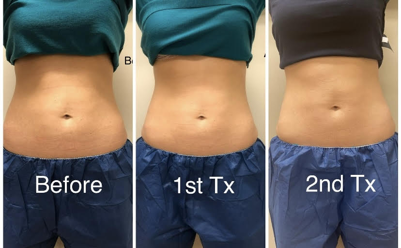 Cooltone Medical Cosmetic Washington DC BBL, muscle builder. Emsculpt, Dupont Circle