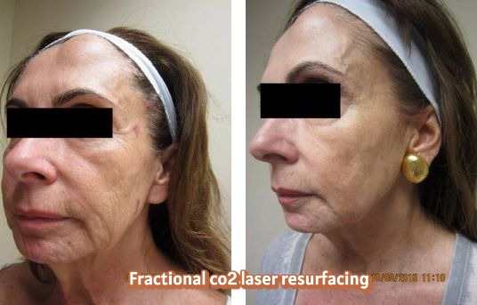 Fraxel , fractional co2 , washington dc, dupont circle, medical cosmetic, dr drew varano, washington dc, laser resurfacing, acne scars,