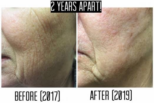 Fraxel , fractional co2 , washington dc, dupont circle, medical cosmetic, dr drew varano, washington dc, laser resurfacing, acne scars, melasma