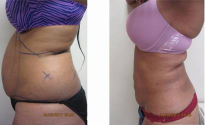 Liposuction 360, Lipo, Laser Liposuction, J plasma, Washington DC , Dupont Circle, Georgetown, Abdomen Liposuction, J plasma, Renuvion, skin tightening, Medical Cosmetic