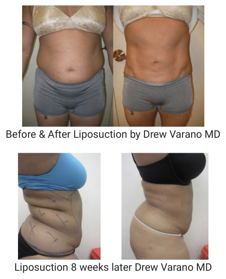 Liposuction 360, Lipo, Laser Liposuction, J plasma, Washington DC , Dupont Circle, Georgetown, Abdomen Liposcution, Medical Cosmetic