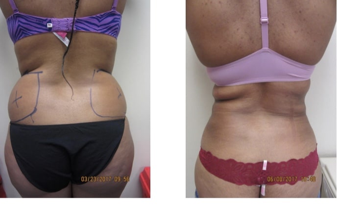Liposuction 360, Lipo, Laser Liposuction, J plasma, Washington DC , Dupont Circle, Georgetown, Abdomen Liposuction, J plasma, Renuvion, skin tightening, Medical Cosmetic