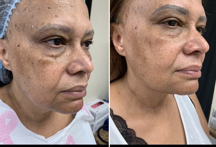 Renuvion, J plasma neck, Washington DC , Dupont Circle, Georgetown, Arlington, Bethesda, submental neck liposuction, double chin liposuction, Medical Cosmetic