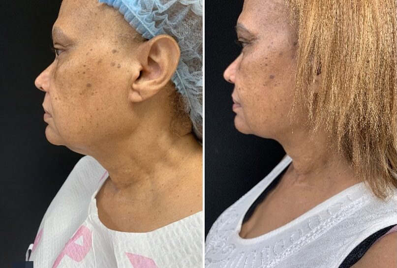 Renuvion, J plasma, Washington DC , Dupont Circle, Georgetown, Arlington, Bethesda, submental neck liposuction, double chin liposuction, Medical Cosmetic