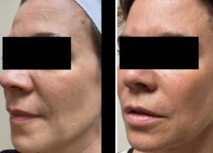 Cheek Juvederm filler at Medical Cosmetic in Washington DC near Dupont circle and Georgetown