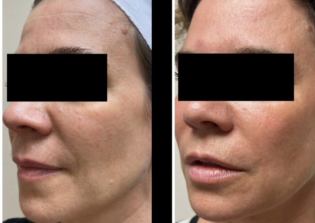 Ultherapy, HIFU, softwave non skin tightening, under eyes, see us Medical Cosmetic in Georgetown, Dupont circle, Bethesda Maryland, Arlington Virginia, washington dc