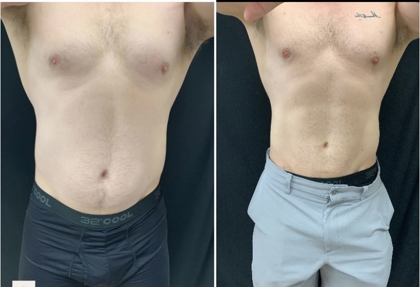 Cooltone Medical Cosmetic Washington DC BBL, muscle builder. Emsculpt, Dupont Circle, Brazillian Butt lift