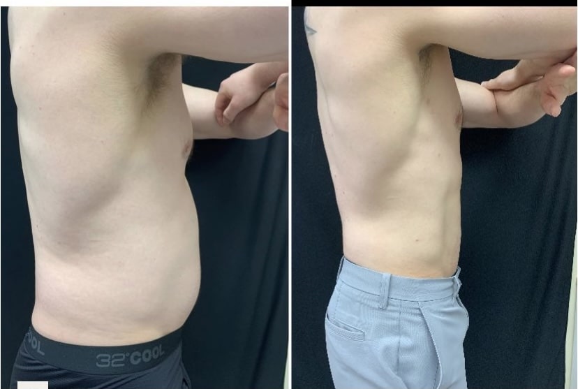 Cooltone Medical Cosmetic Washington DC BBL, muscle builder. Emsculpt, Dupont Circle, Brazillian Butt lift