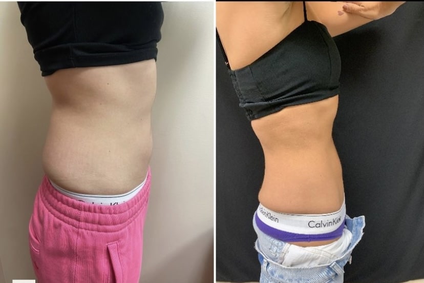 Cooltone Medical Cosmetic Washington DC BBL, muscle builder. Emsculpt, Dupont Circle