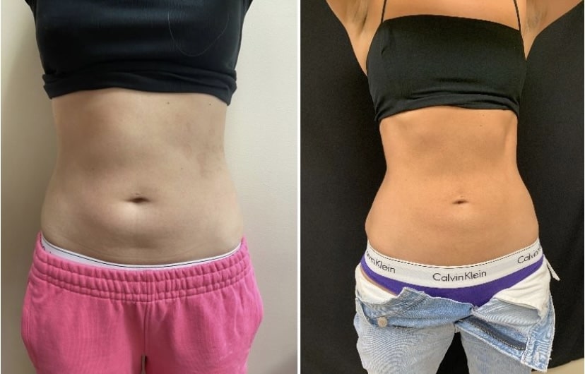 Cooltone Medical Cosmetic Washington DC BBL, muscle builder. Emsculpt, Dupont Circle, Brazillian Butt lift