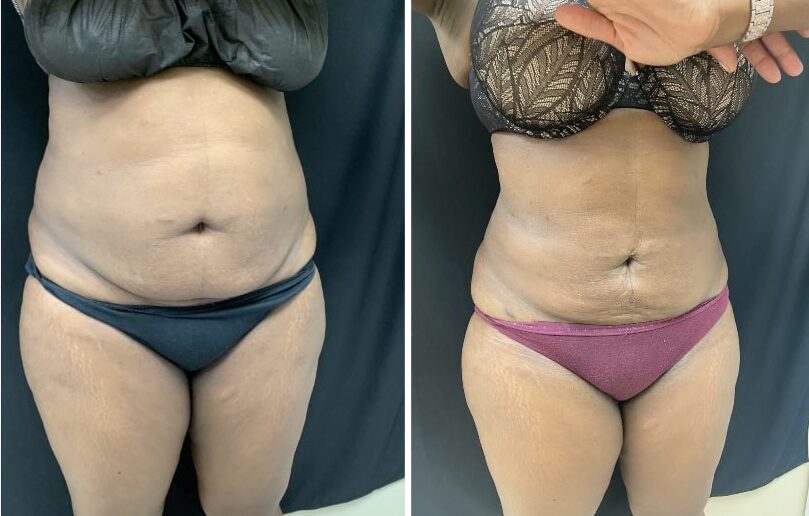 Renuvion, J-Plasma for skin tightening. tummy tuck, Medical Cosmetic by Dr. Drew Varano in Washington dc , Dupont Circle , Georgetown also Bethesda Maryland and Arlington Virginia