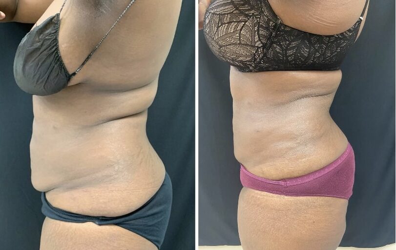 Renuvion, J-Plasma for skin tightening. tummy tuck, Medical Cosmetic in Washington dc , Dupont Circle , Georgetown also Bethesda Maryland and Arlington Virginia