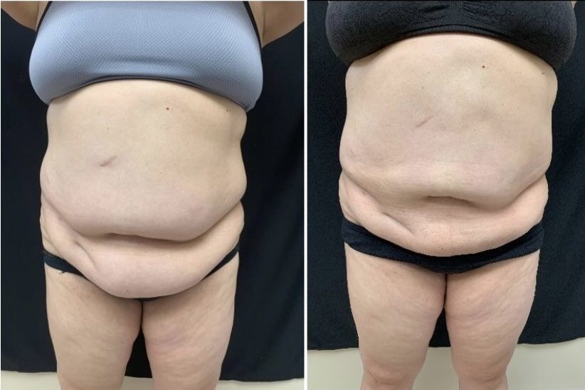 Renuvion, J-Plasma for skin tightening. tummy tuck, Medical Cosmetic in Washington dc , Dupont Circle , Georgetown also Bethesda Maryland and Arlington Virginia