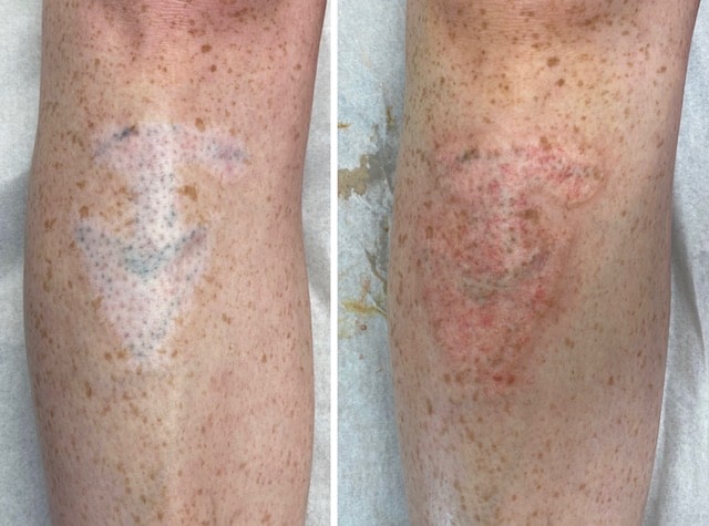 Medical Tattoo, Camouflage tattoo, areola restoration, facelift scar restoration, medical tattoo camouflage, scar camouflage, post mastectomy tattoo, Medical Cosmetic, Washington DC, arlington virginia, bethesda maryland, dupont circle, georgetown