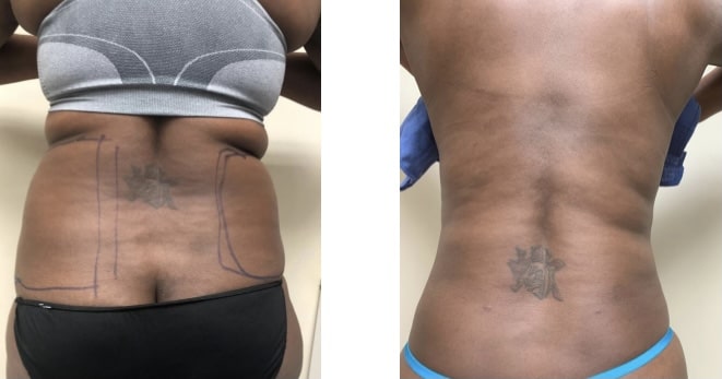 Liposuction 360, Lipo, Laser Liposuction, J plasma, Washington DC , Dupont Circle, Georgetown, Arlington, Bethesda, Back Liposuction, Bra roll liposuction, Medical Cosmetic